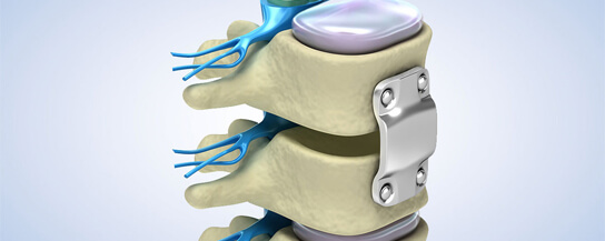 Oblique Lumbar Fusion (1) Oblique Lumbar Fusion